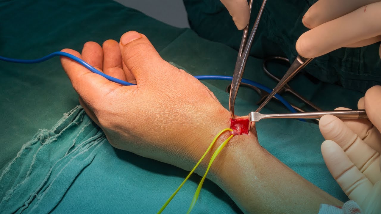 La fístula arteriovenosa es la mejor opción para la hemodiálisis