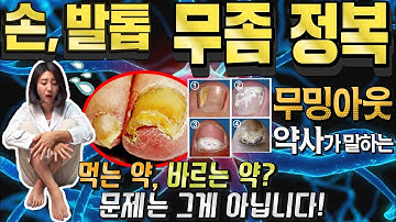 발톱 무좀, 손톱 무좀 정복을 위한 약사의 이야기! 무좀 약 선택이 우선이 아닙니다!