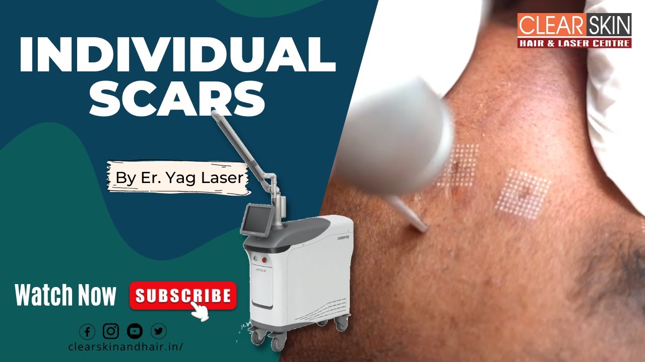 Fractional Erbium YAG Laser Treatment for Acne Scars Best Laser