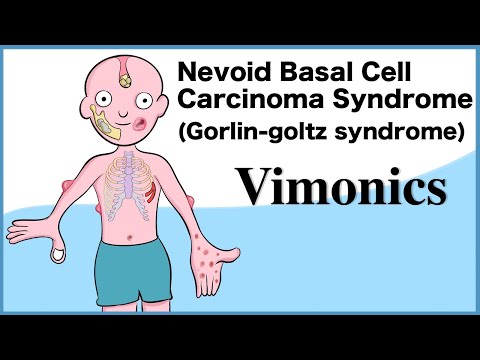 Nevoid Basal Cell Carcinoma Syndrome (Gorlin-goltz syndrome): Visual mnemonics