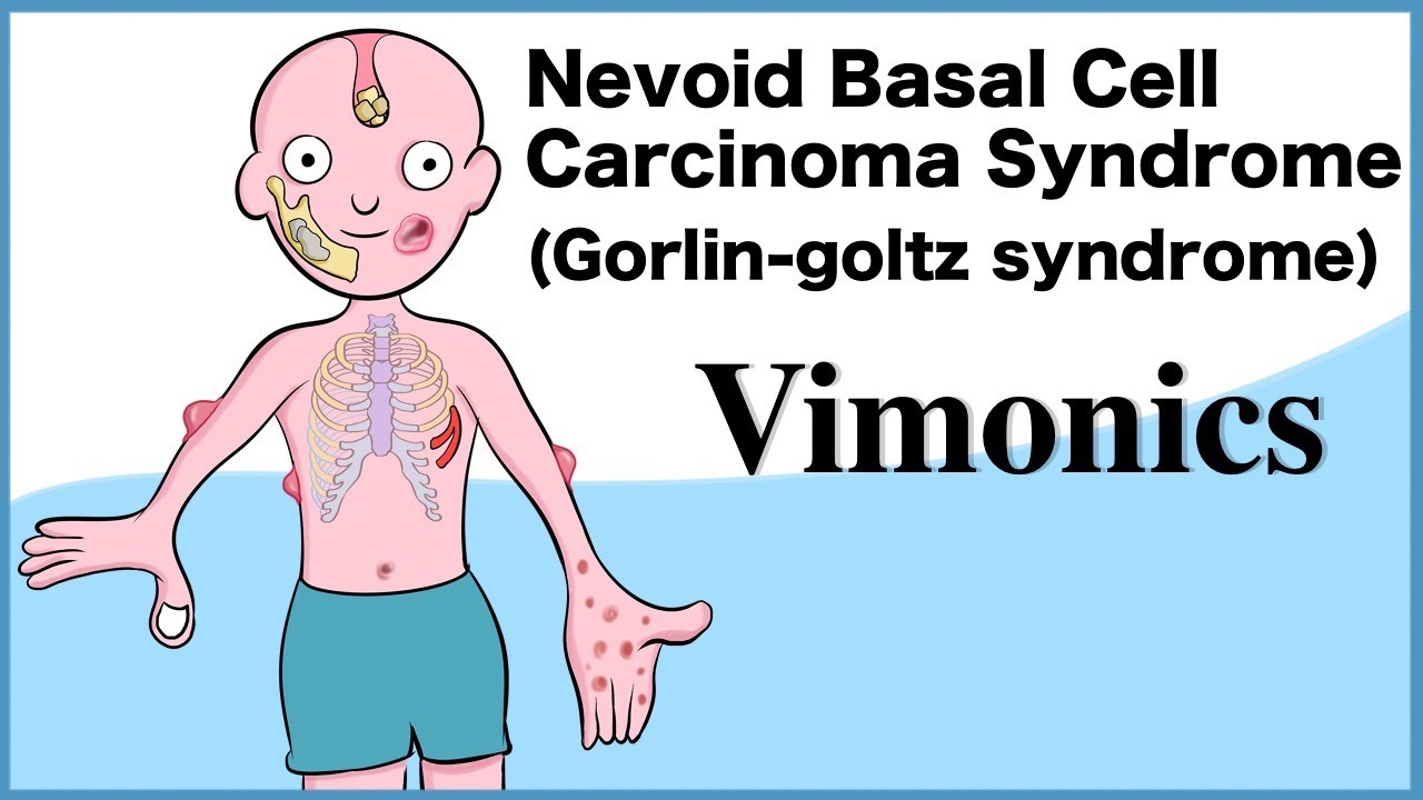 gorlin syndrome