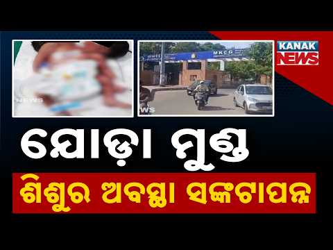 ଯୋଡ଼ାମୁଣ୍ଡ ଶିଶୁର ଅବସ୍ଥା ସଙ୍କଟାପନ୍ନ, Berhampur MKCG Hospital | Critical Condition of Conjoined Twins