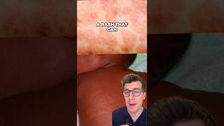 Measles rash - what it looks like on different skin types #shorts #health