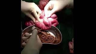 عملية إزالة الدودة الشريطية من الأمعاء