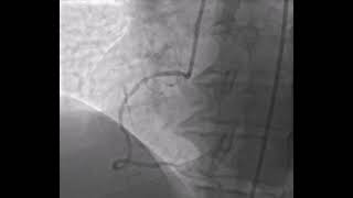 Video 2.5 ANJİOGRAFİK AÇILARIN ÖNEMİ