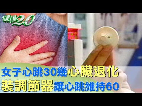 女子心跳30幾心臟退化 裝調節器讓心跳維持60 健康2.0 ‪@tvbshealth20‬