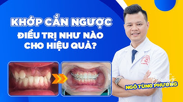 Khớp Cắn Ngược Điều Trị Như Thế Nào?