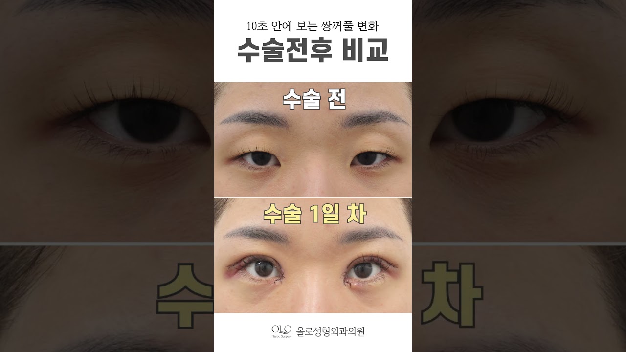 [奧樂整形外科診所] #初雪手術在 #奧樂整形外科 真的開眼了，千真萬確 #真實 #真的 #短片