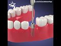 Teeth mechanical video