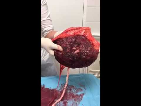 Video: Heeft de placenta een hartslag?