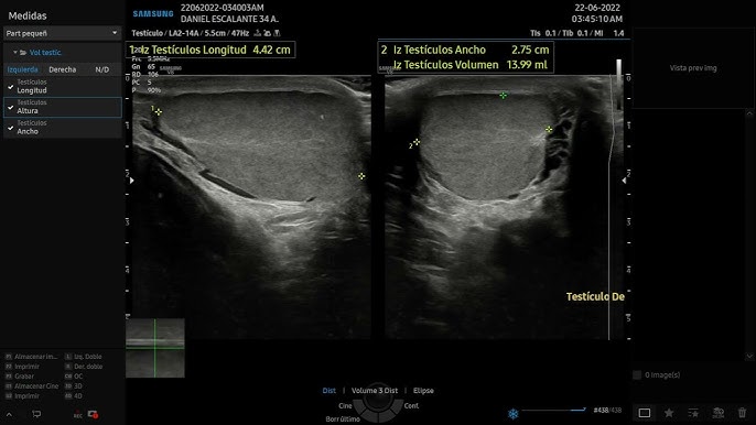 19+ Ecotomografia Doppler Color