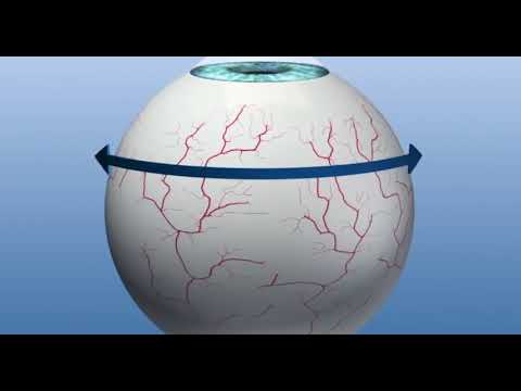 Small Incision Lenticule Extraction Of Astigmatism- Twist In The Tale ...