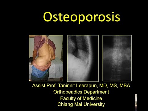 Osteoporosis for medical student