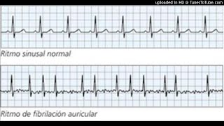 Fibrilación Auricular Ecoe Podcast Eunacom-Sp