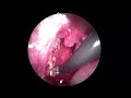 CASO CIRÚRGICO - CIRURGIA DAS AMÍGDALAS COM MENOS RISCOS (COBLATION)