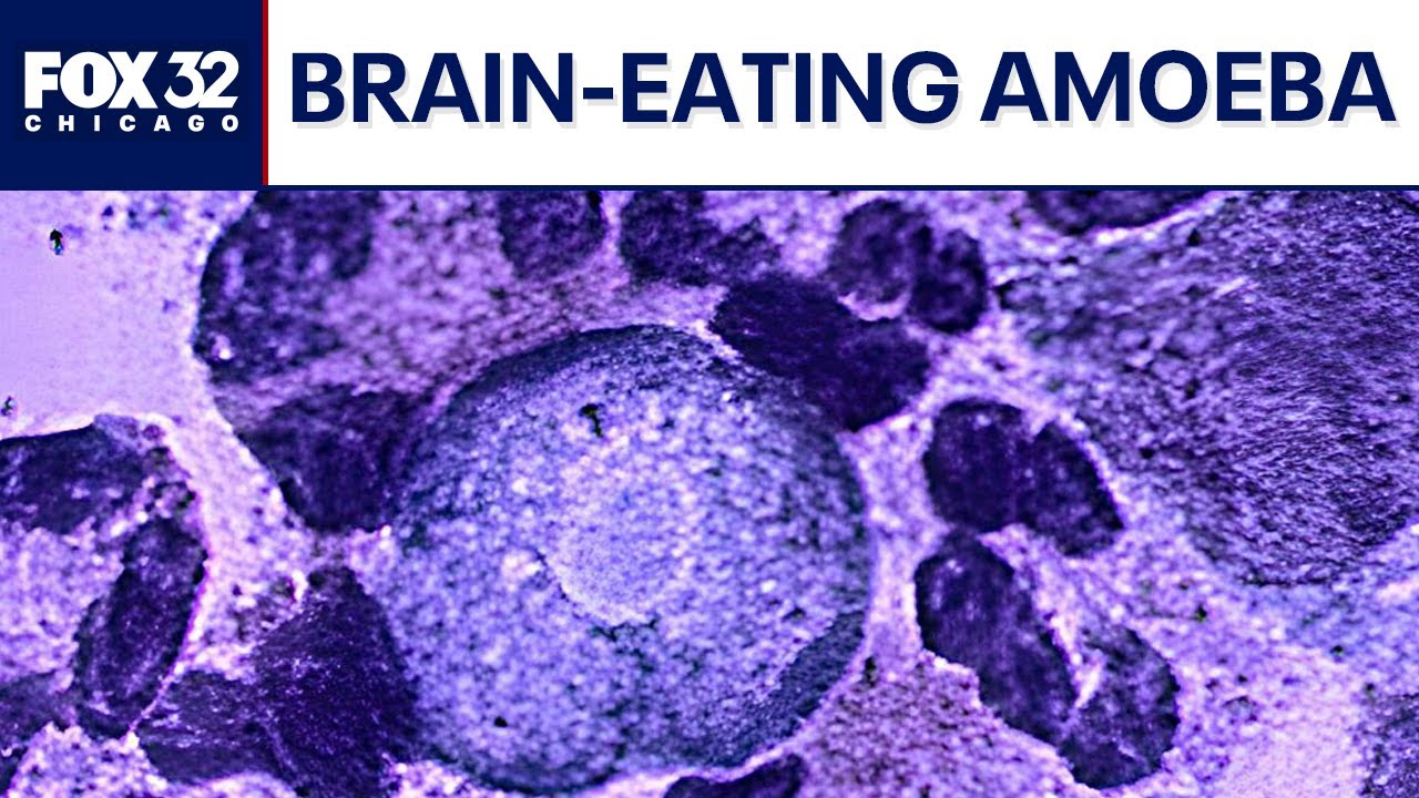 Woman diagnosed with brain-eating amoeba after water skiing — local doctor weighs in