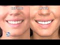 Is There a Way to Whiten Teeth Instantly?