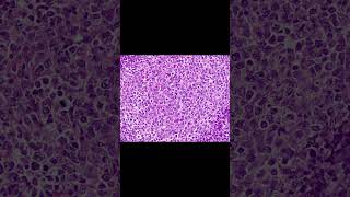 Your body gives you clues. Are you listening? #EarlyDetection #Follicularlymphoma #Lymphoma #cancer