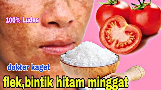 DOKTER KAGET!FLEK DAN BINTIK HITAM HILANG CUMA DENGAN TOMAT DAN GARAM