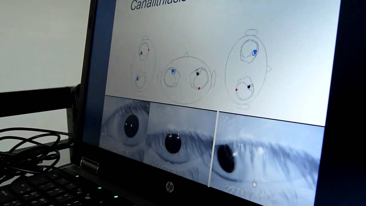 geotrtohic nystagmus of canalithiasis of HC-BPPV,Lt - YouTube
