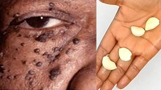 Only 3 days remove skin tag mole and wart