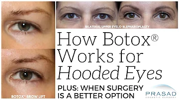 How do you lift up hooded eyelids?