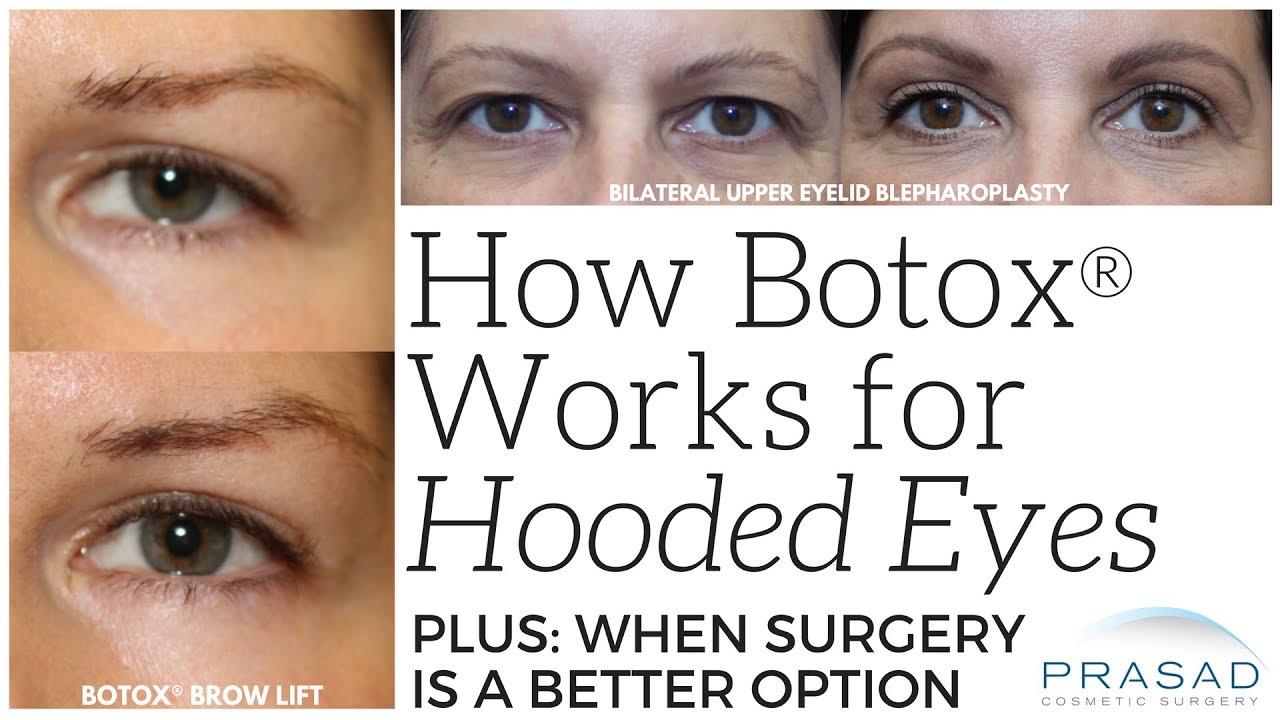 eyelid droop after botox treatment