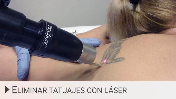 Borrado de tatuajes - Zonas muy pequeñas