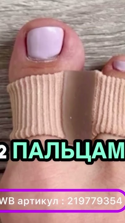 Решение есть! вальгусная деформация БЕЗ операции Hallux Valgus ОМС ...