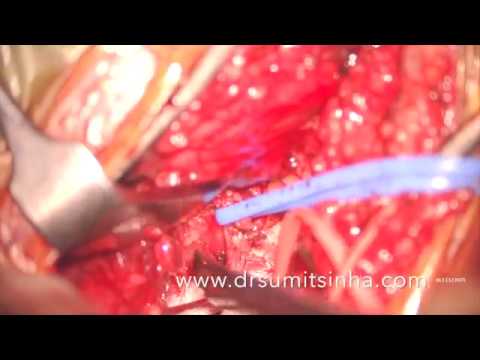 He is an expert Minimally invasive and Endoscopic Neurosurgeon and Spine Surgeon. He has to his credit performing successfully thousands of complex Neurosurgical and Spine operations through keyhole and endoscopic approaches.