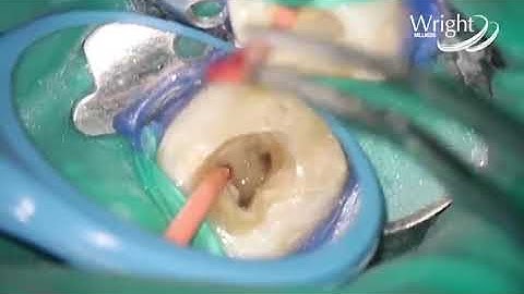 Dr Seedat and Hyflex EDM