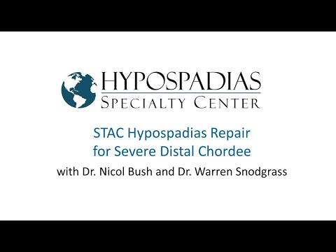 STAC hypospadias repair for severe distal chordee