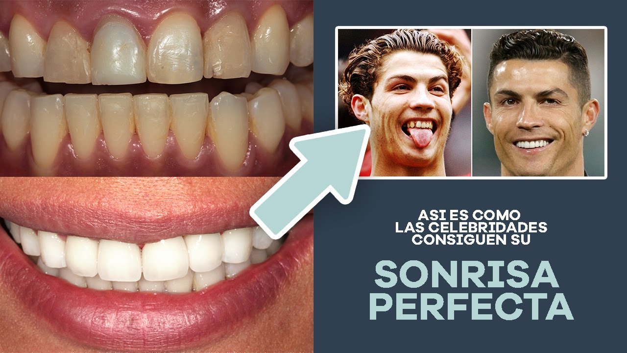 Carillas Dentales En Tijuana Qu Son Para Qu Sirven The Dental 