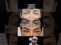 JIYA | Touch up | Eyelid Surgery