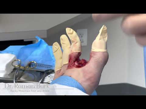 Toe Amputation!