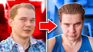8 Year Minoxidil Results And Long Term Progress And Temple Regrowth
