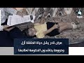 مرض نادر يشل حياة الطفلة أزل وذووها يناشدون الحكومة لعلاجها تقرير إدريس يحيى مرض نادر يشل حياة الطفلة أزل وذووها يناشدون الحكومة لعلاجها تقرير إدريس يحيى