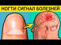 НОГТИ - предвестники СТРАШНЫХ БОЛЕЗНЕЙ. Диагностика болезней по ногтям