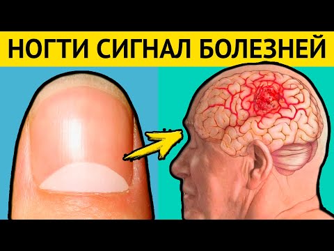 НОГТИ - предвестники СТРАШНЫХ БОЛЕЗНЕЙ. Диагностика болезней по ногтям