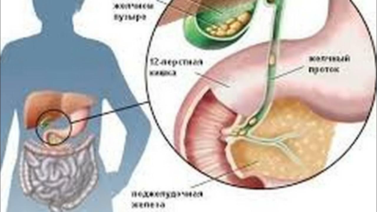 Холецистит камень в желчном пузыре. Желчекаменная болезнь холелитиаз. Застой желчи в желчном пузыре. Камни из желчного пузыря.