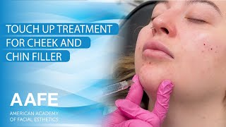 Touch Up Treatment for Cheek and Chin Filler