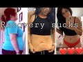 Tummy Tuck after 100 pound weight loss [week 1 - week 3] Real Footage!