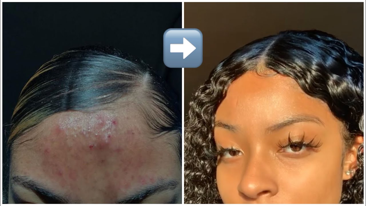 Skin care routine / how I cleared up my acne prone skin - YouTube
