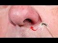 如果蚊子不小心飛進鼻子，會發生什麼？