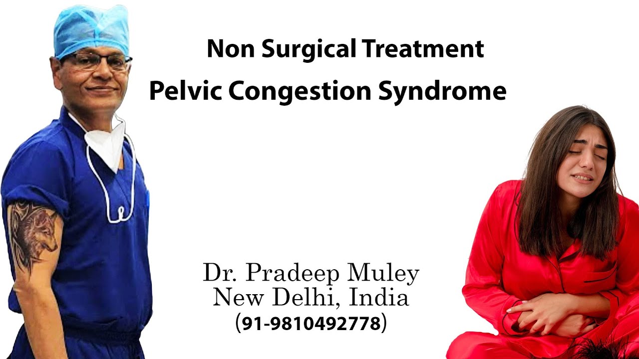 Pelvic Congestion Syndrome treated by ovarian vein embolization