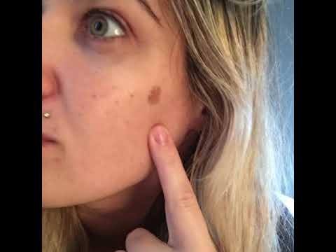 Compound W for Age Spot Removal