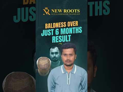 Mumbai मध्ये Hair Transplant चा कमाल! Grade 4 Baldness आता गायब #hairtransplant #mumbai #shorts