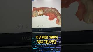하단치과 치주염 치료 비용 과정
