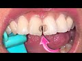 GIGI DEPAN BOLONG | Tambal Gigi | Dentist | Dokter Gigi Tri Putra