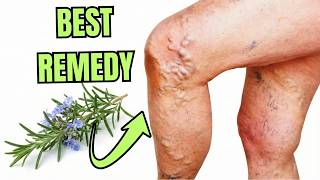 How to Make Varicose Veins Disappear Fast
